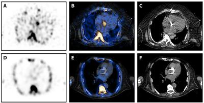 99mTc-Besilesomab-SPECT/CT in Infectious Endocarditis: Upgrade of a Forgotten Method?